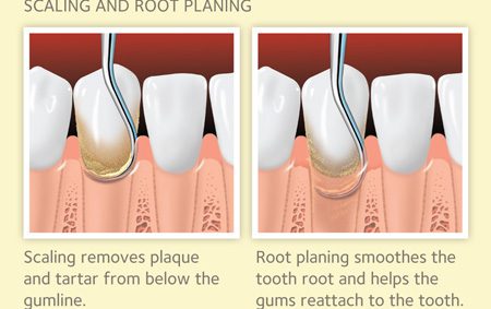 Periodontal Scaling and Root Planing Necessary