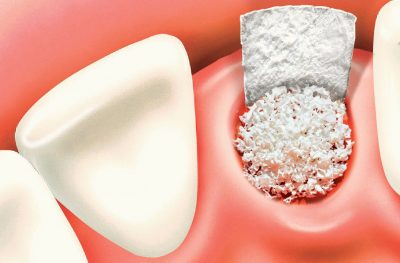 Andidate for Tooth Extractions
